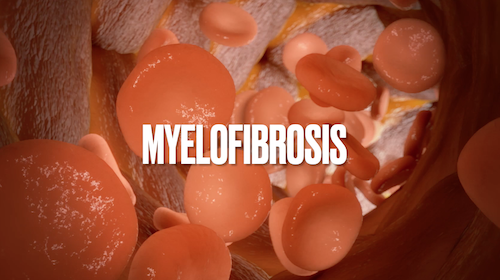 Myelofibrosis: Disease Basics